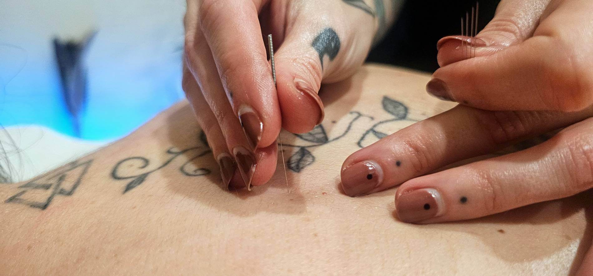 Acupuntura + Medicina Tradicional China